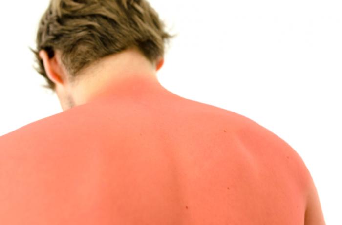 man showing sunburnt back
