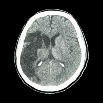 A CT scan of ischemic stroke