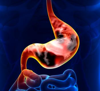 An illustration of stomach cancer