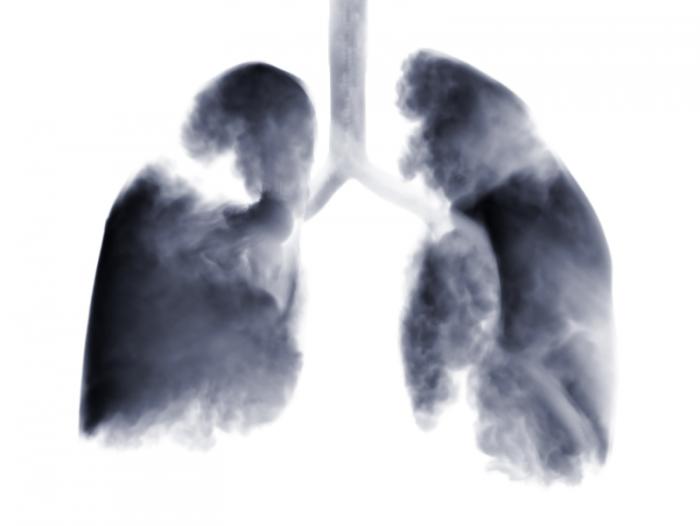 An X-ray of lung cancer
