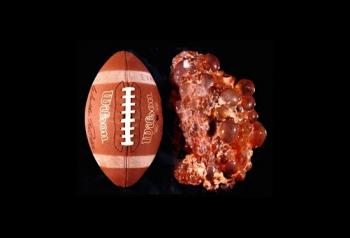 polycystic kidney next to American football