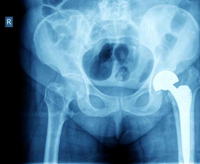 An X-ray image showing a hip implant.