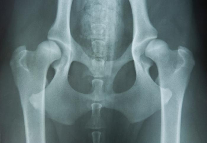 An x-ray showing hip dysplasia.