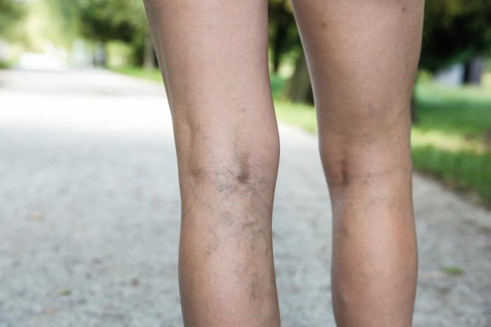Legs with varicose veins.