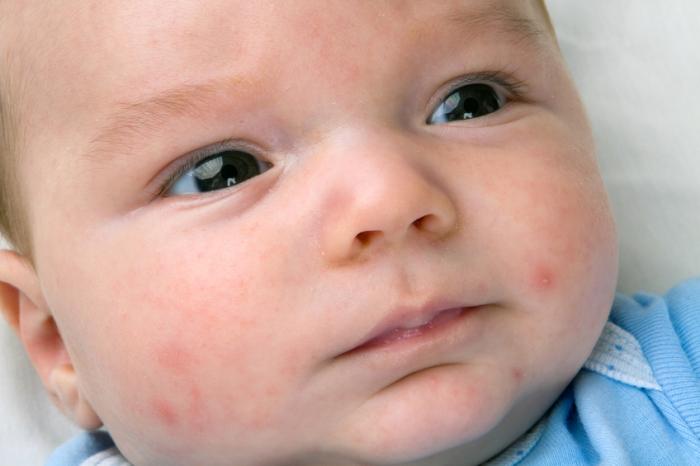 A baby with acne on its face.