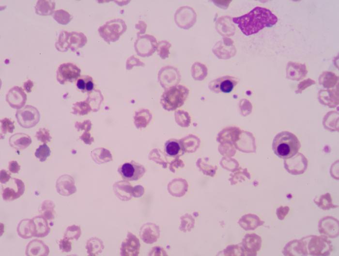 A blood slide showing anemia.