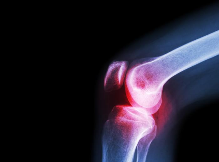 [An X-ray of knee osteoarthritis]