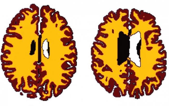 [Brain scans of a lean vs. an overweight person]