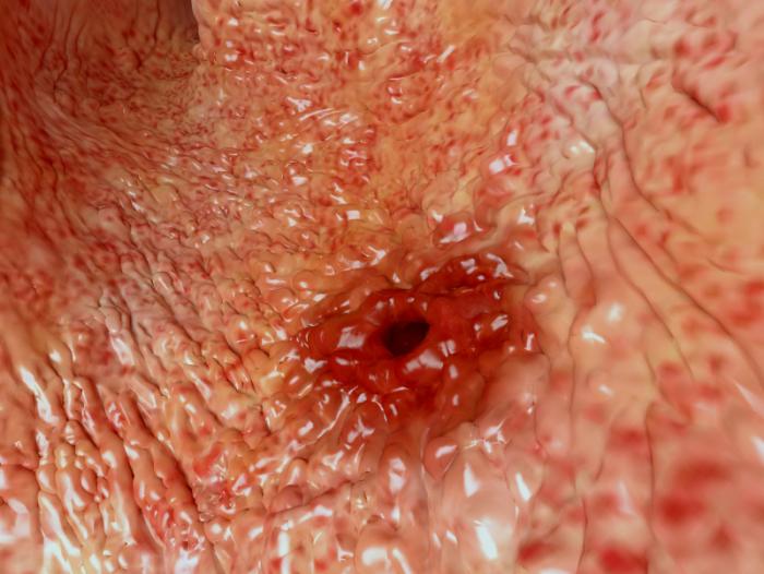 Image of a stomach ulcer.