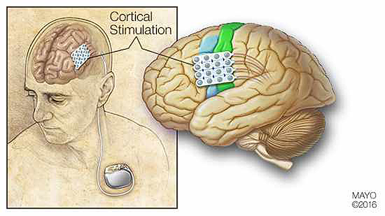 cortical-stimulation