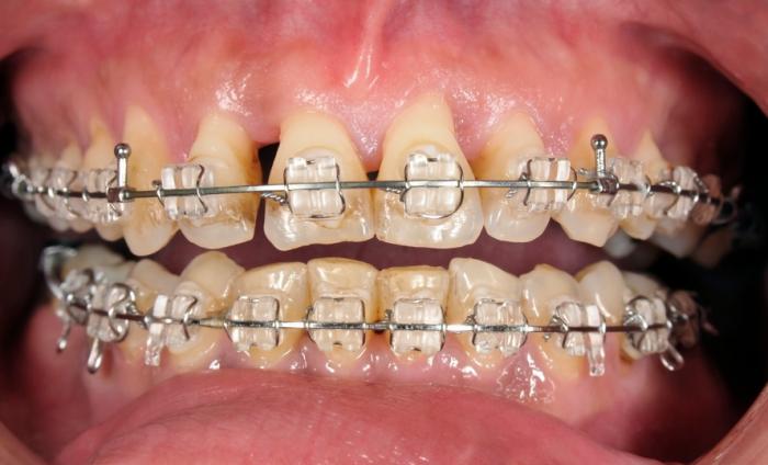 [teeth with braces]
