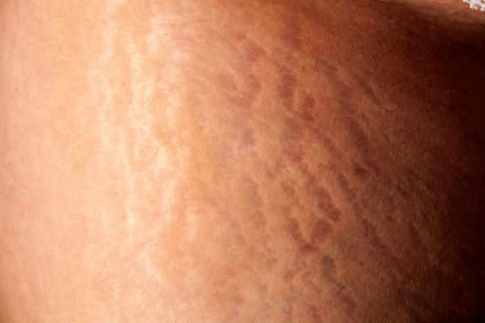[Close up of stretch marks]
