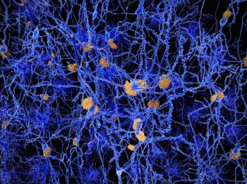 Beta-amyloid plaques between nerve cells