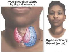 Overcome the Hyperthyroidism