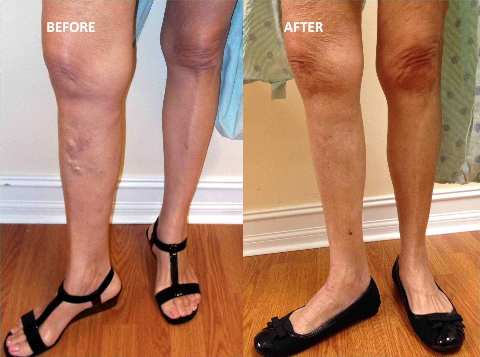 Different Non-Surgical Medications And Cost OF varicose vein