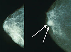 Scientists successfully combine with immunotherapy to attack breast cancer cells