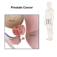  Prostate cancer