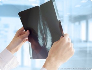 Researcher could assess the risk of false-positive mammogram the women’s cancer in the future