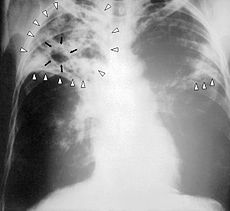 230px-Tuberculosis-x-ray-1