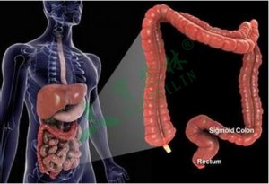 Studies have Shown that Increase the Risk of Ovarian Resection of Colorectal Cancer