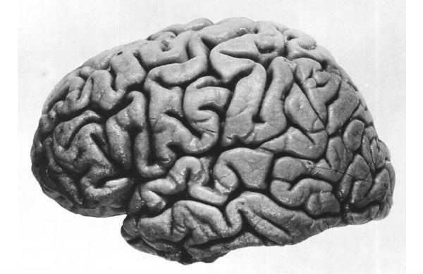 mdt-brain-left-hemisphere-2