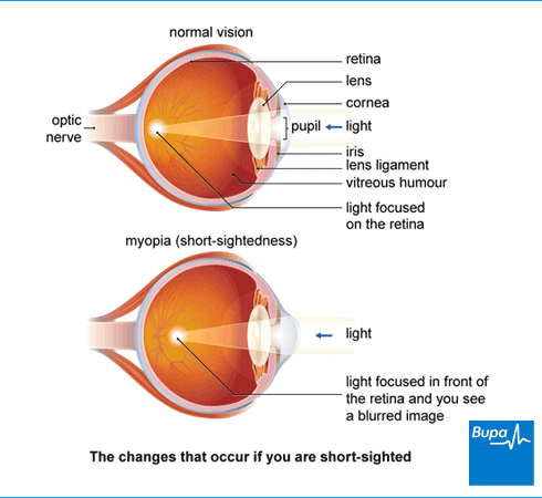 Why We Get Short-sightedness? How to prevent it？