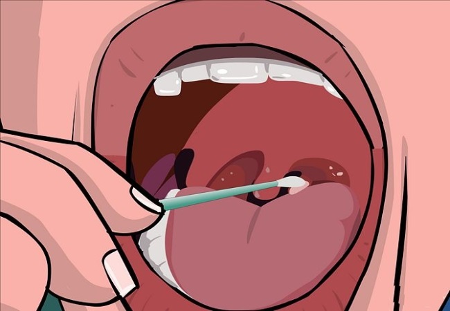 How to Prevent Tonsil Stones