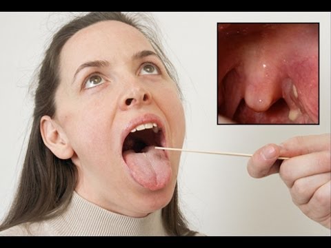 How to Prevent Tonsil Stones