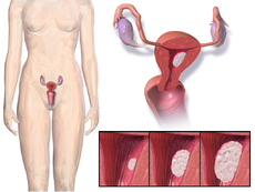 minimally invasive hysterectomies for uterine cancer