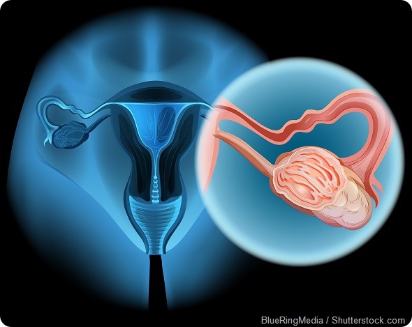 Clinical trial data indicate that screening reduces mortality from ovarian cancer
