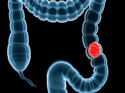 Studies have Shown that Increase the Risk of Ovarian Resection of Colorectal Cancer