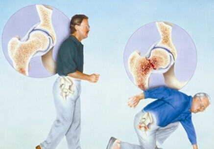 Male Friends not to be Missed Osteoporosis Screening