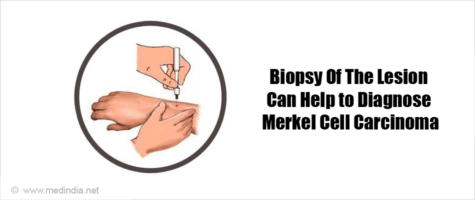 Biopsy Of The Lesion Can Help to Diagnose Merkel Cell Carcinoma