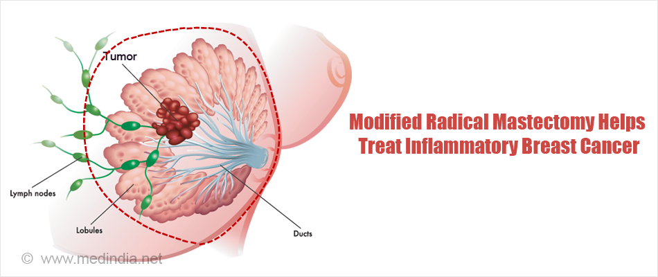 Modified Radical Mastectomy Helps Treat Inflammatory Breast Cancer