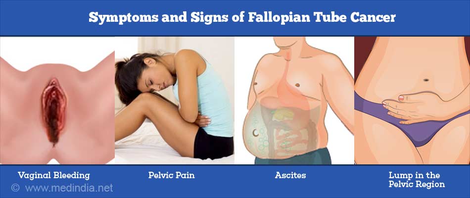 Symptoms and Signs of Fallopian Tube Cancer