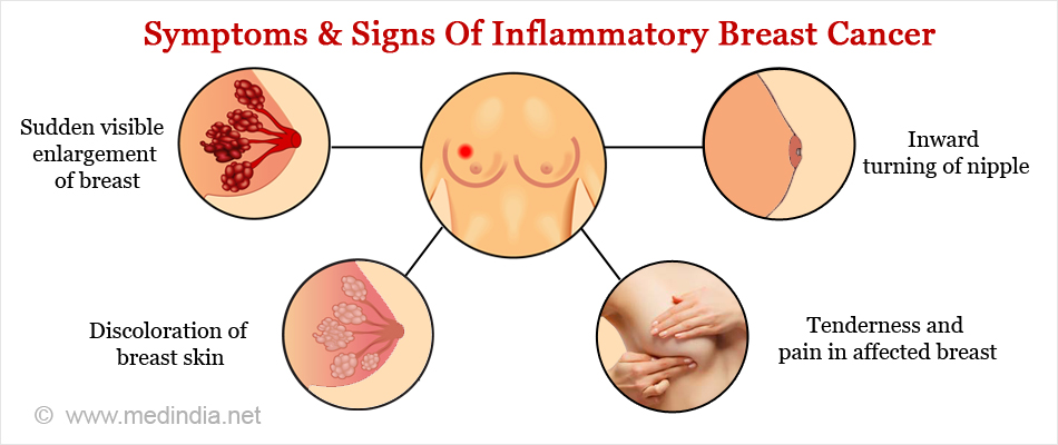 Symptoms & Signs Of Inflammatory Breast Cancer