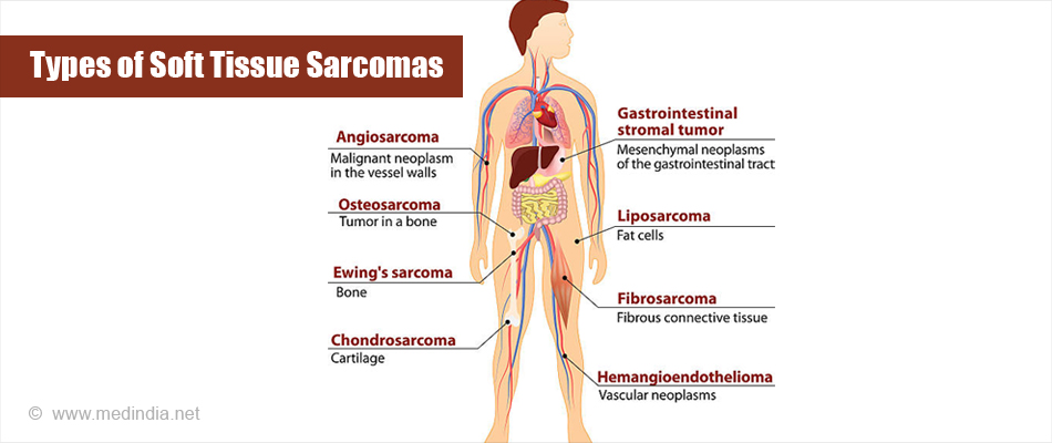 Types of Soft Tissue Sarcomas